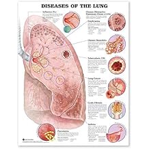 Diseases of the Lung Anatomical Chart